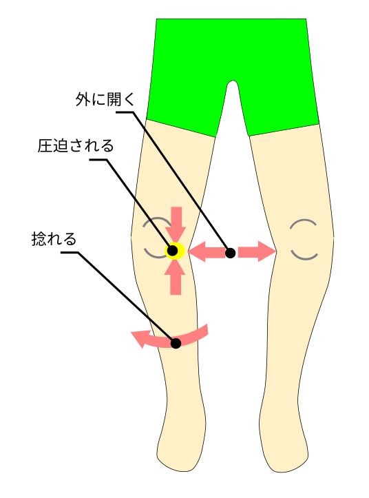 変形性膝関節症の下肢