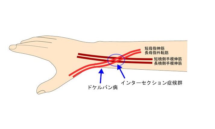 インターセクション症候群