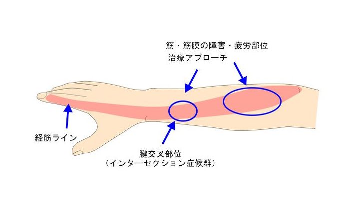 インターセクション症候群の鍼灸治療