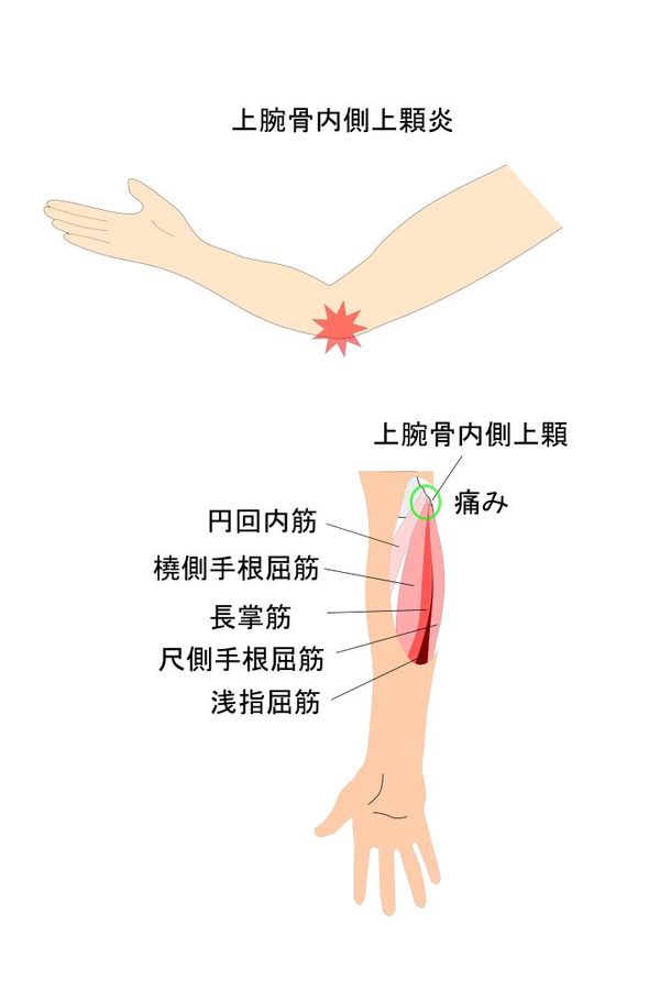 上腕骨内側上顆炎イラスト
