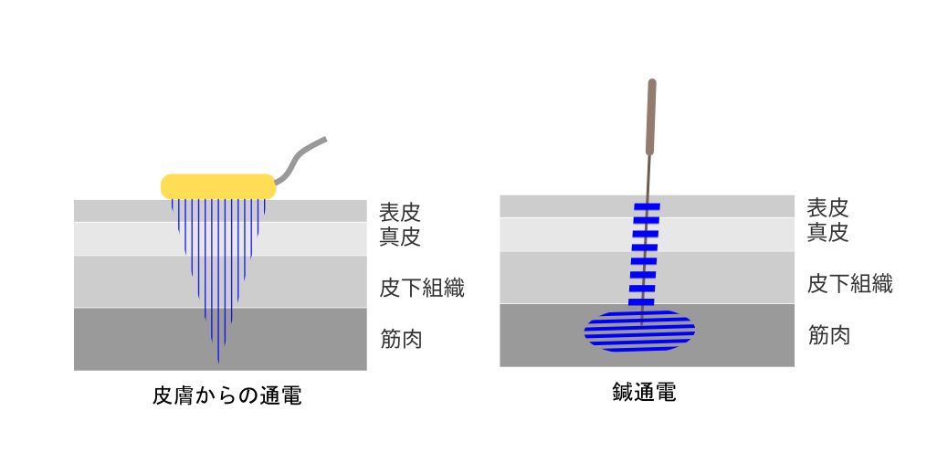 経皮通電と鍼通電