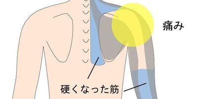 肩の痛みと経筋
