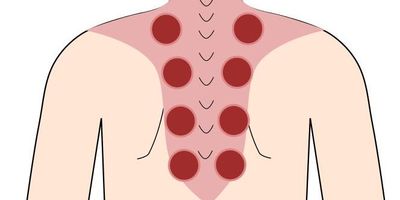 僧帽筋吸角施術