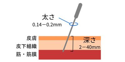 鍼灸の不安解消